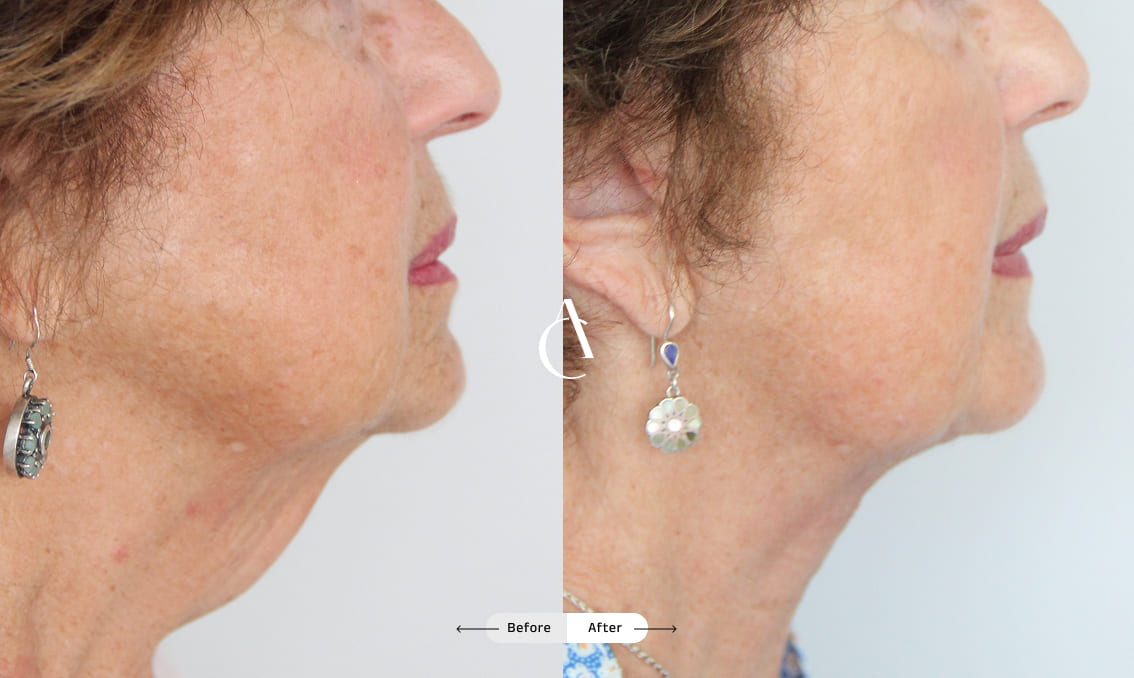 TP – Plastic surgery face – 11 TP – Plastic surgery face – 11