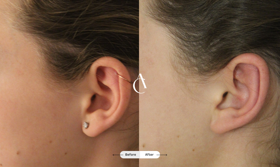 TP – Plastic surgery face – 12 TP – Plastic surgery face – 12