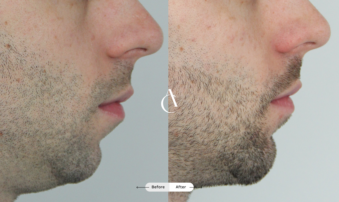 TP – Plastic surgery face – 2 TP – Plastic surgery face – 2