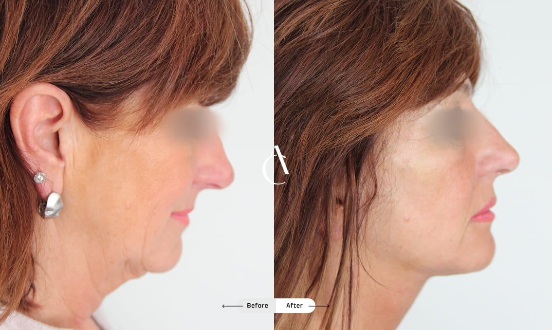 TP – Plastic surgery face – 4 TP – Plastic surgery face – 4