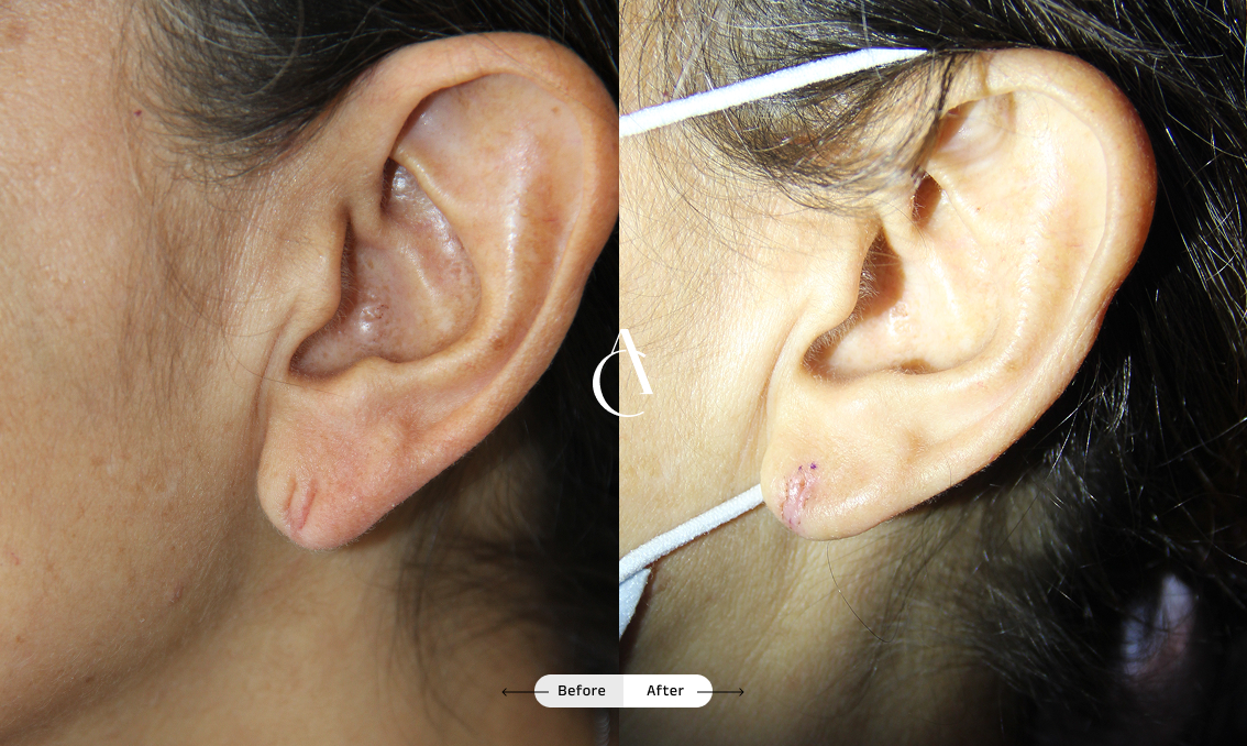 TP – Plastic surgery face – 6 TP – Plastic surgery face – 6