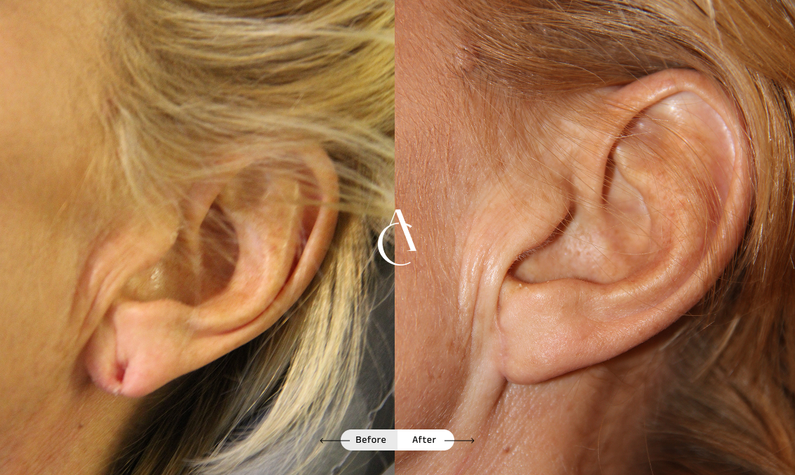 TP – Plastic surgery face – 8 TP – Plastic surgery face – 8