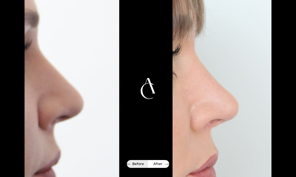 TP – Primary Rhinoplasty – 1 TP – Primary Rhinoplasty – 1