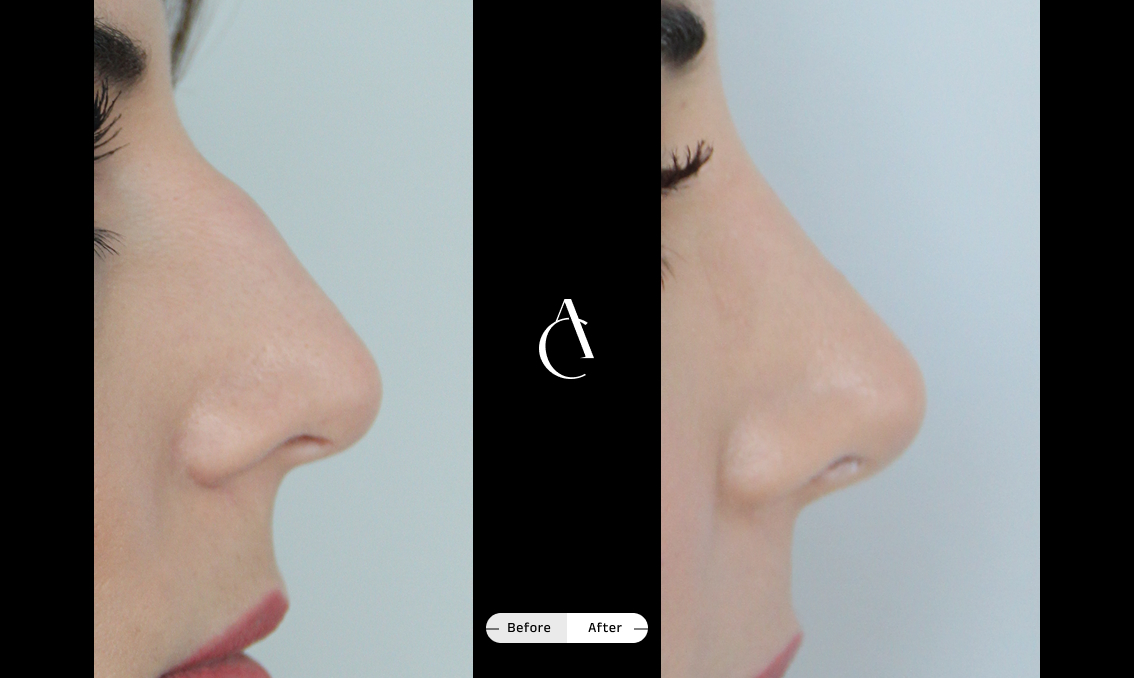 TP – Primary Rhinoplasty – 2 TP – Primary Rhinoplasty – 2