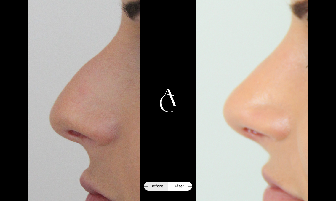 TP – Primary Rhinoplasty – 3 TP – Primary Rhinoplasty – 3