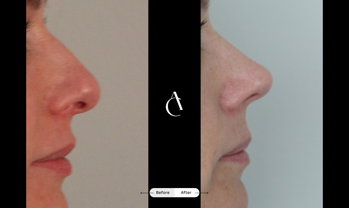 TP – Primary Rhinoplasty – 6 TP – Primary Rhinoplasty – 6