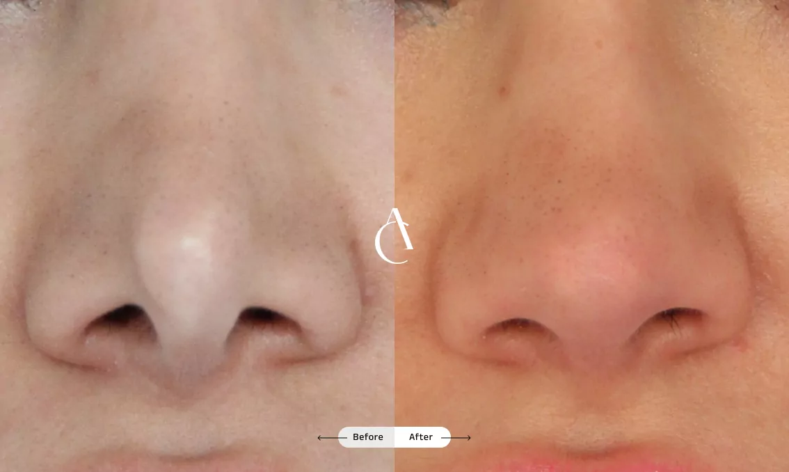 TP – Functional Rhinoplasty – 1