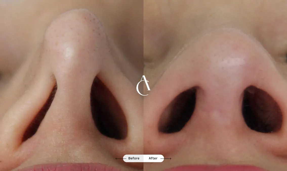 TP – Functional Rhinoplasty – 2