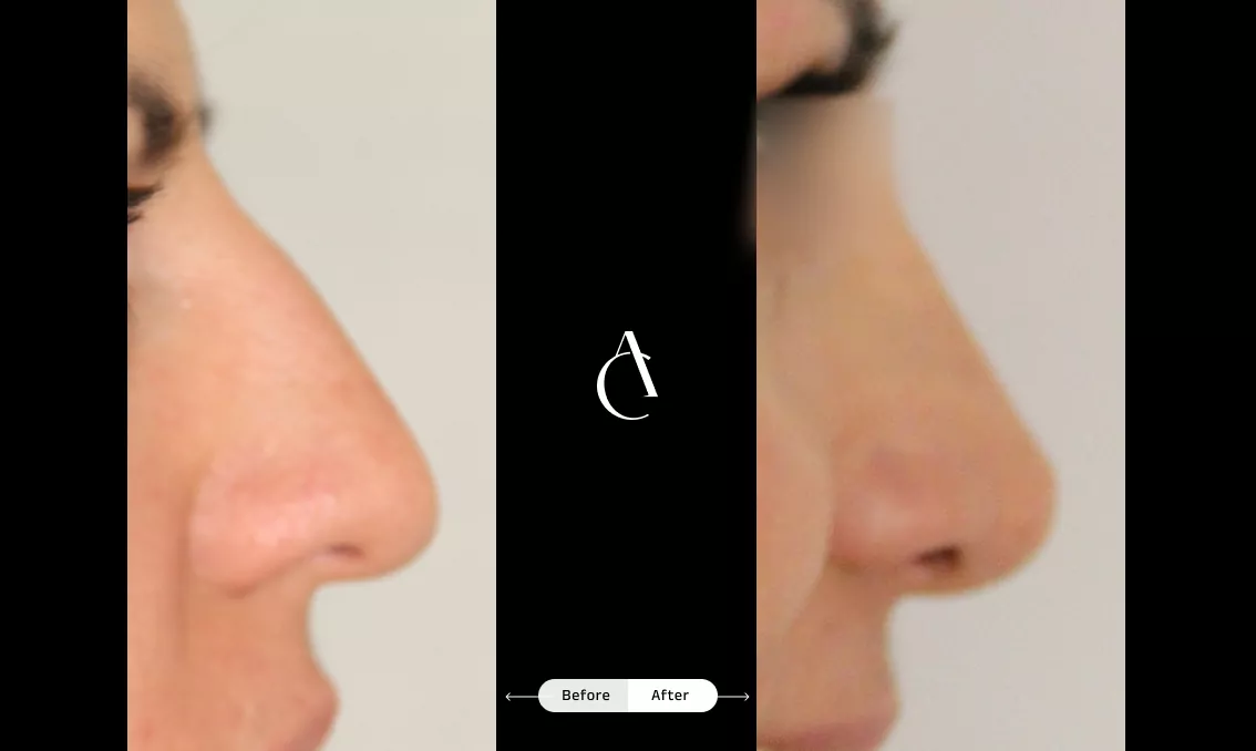 TP – Functional Rhinoplasty – 3