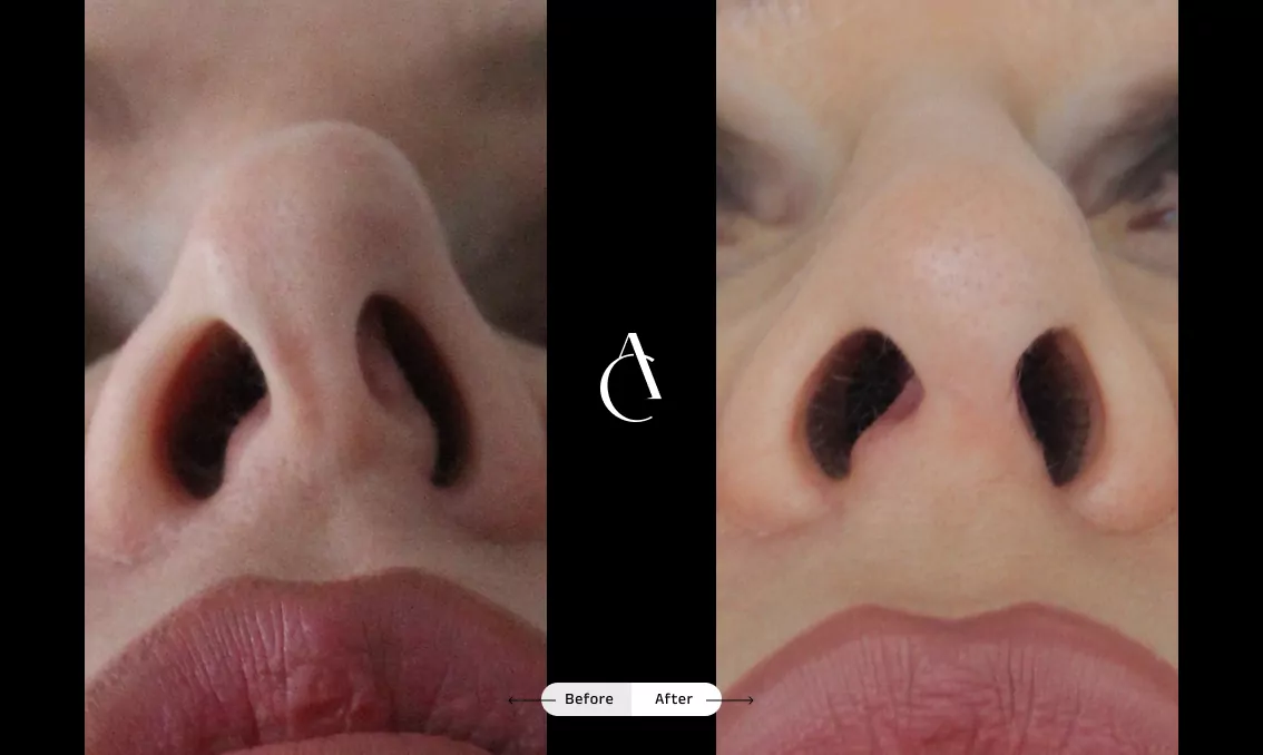 TP – Functional Rhinoplasty – 4