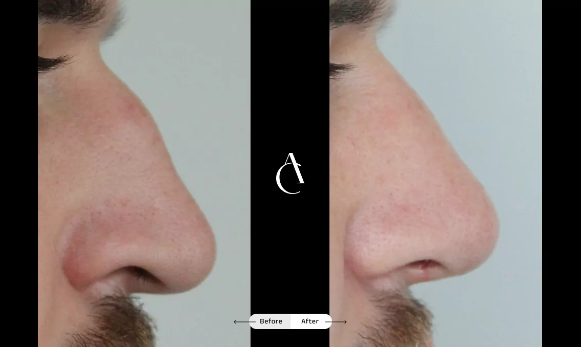 TP – Functional Rhinoplasty – 5