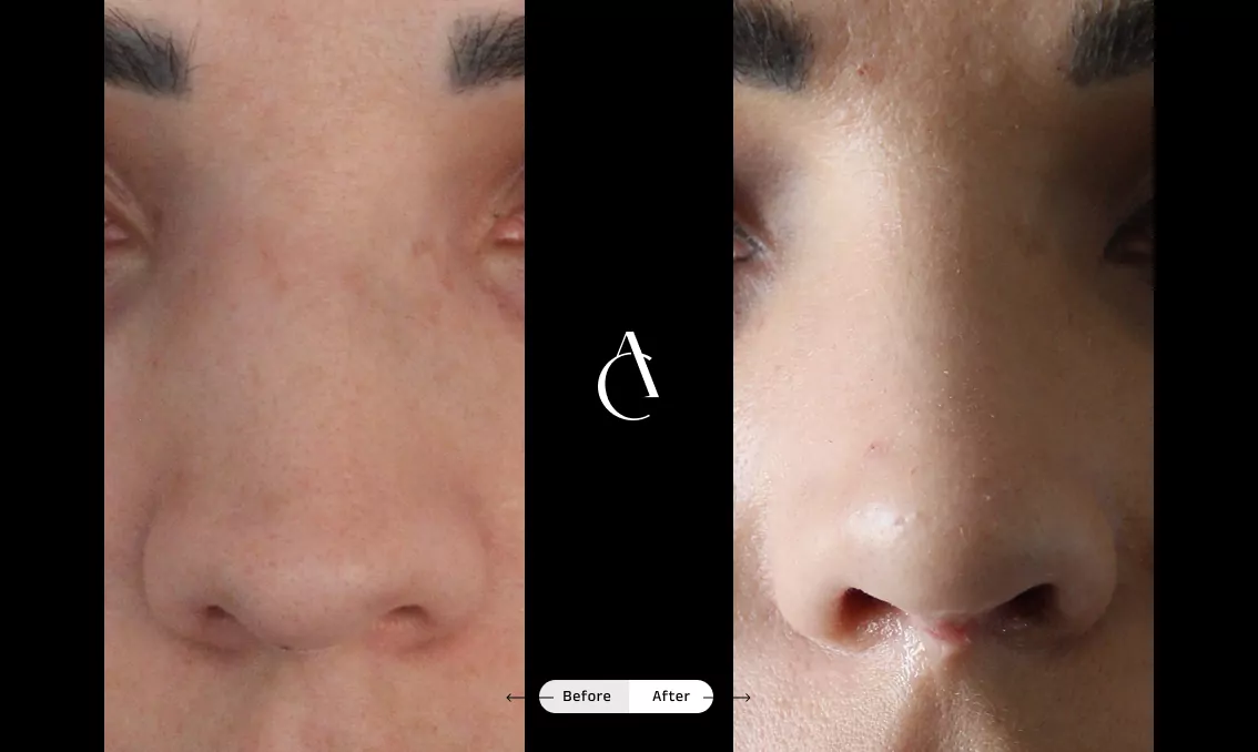 TP – Functional Rhinoplasty – 6