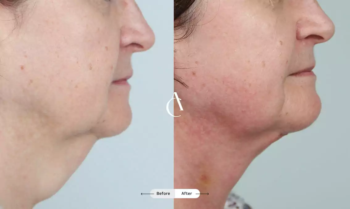 TP – Plastic surgery face – 10 TP – Plastic surgery face – 10