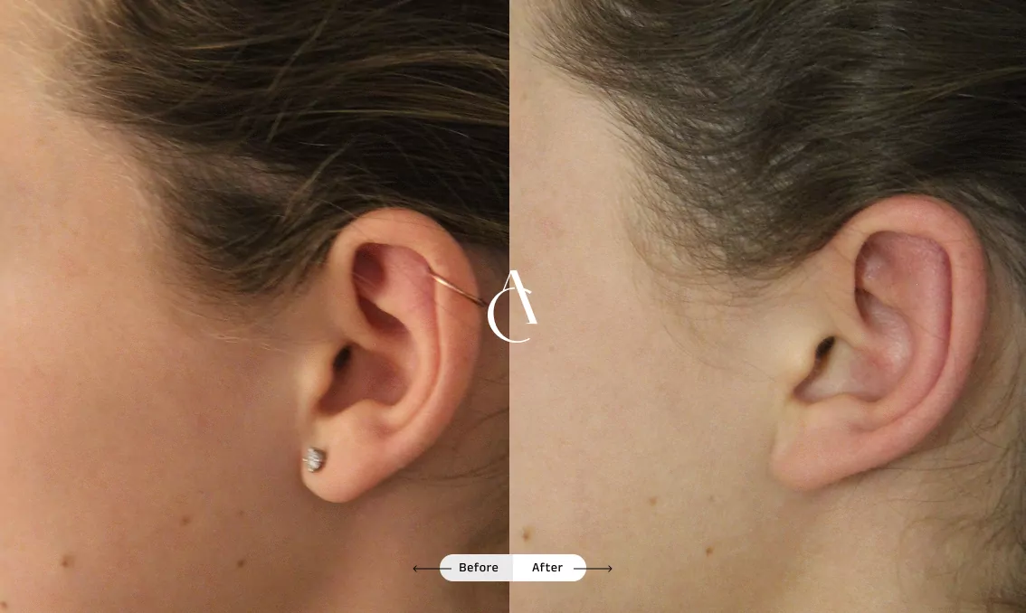TP – Plastic surgery face – 12 TP – Plastic surgery face – 12