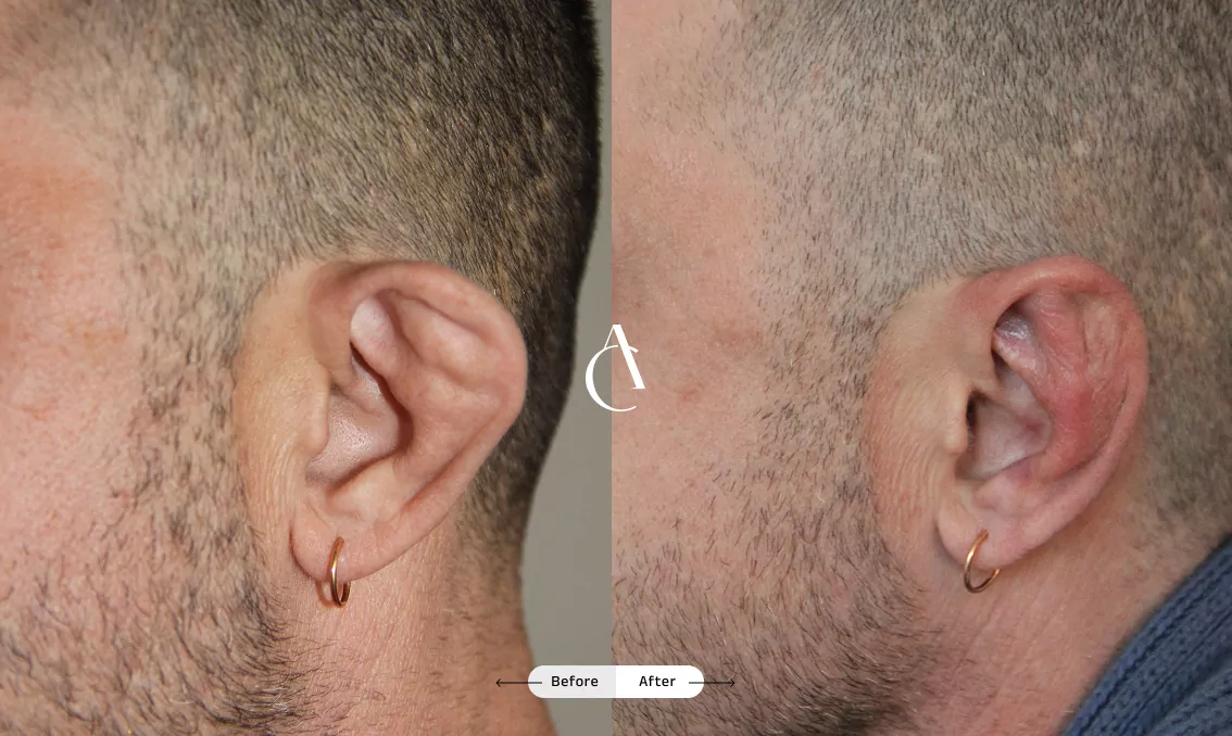 TP – Plastic surgery face – 13