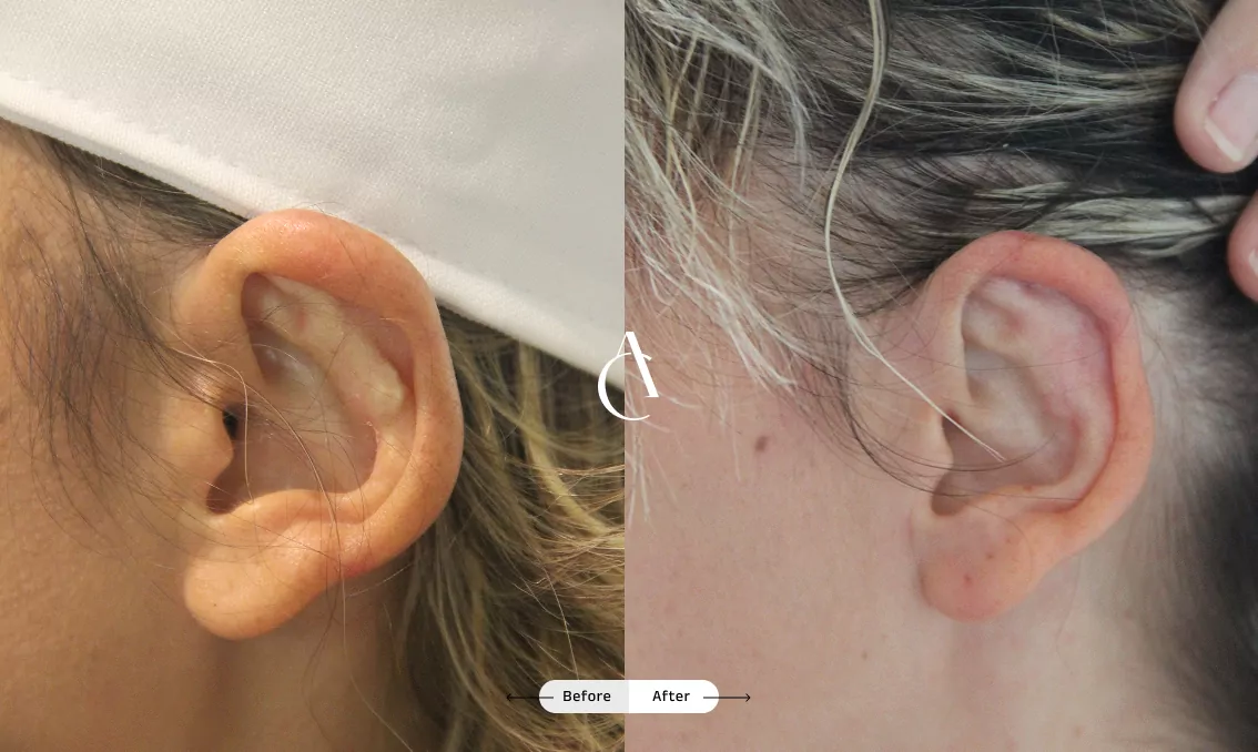 TP – Plastic surgery face – 14 TP – Plastic surgery face – 14