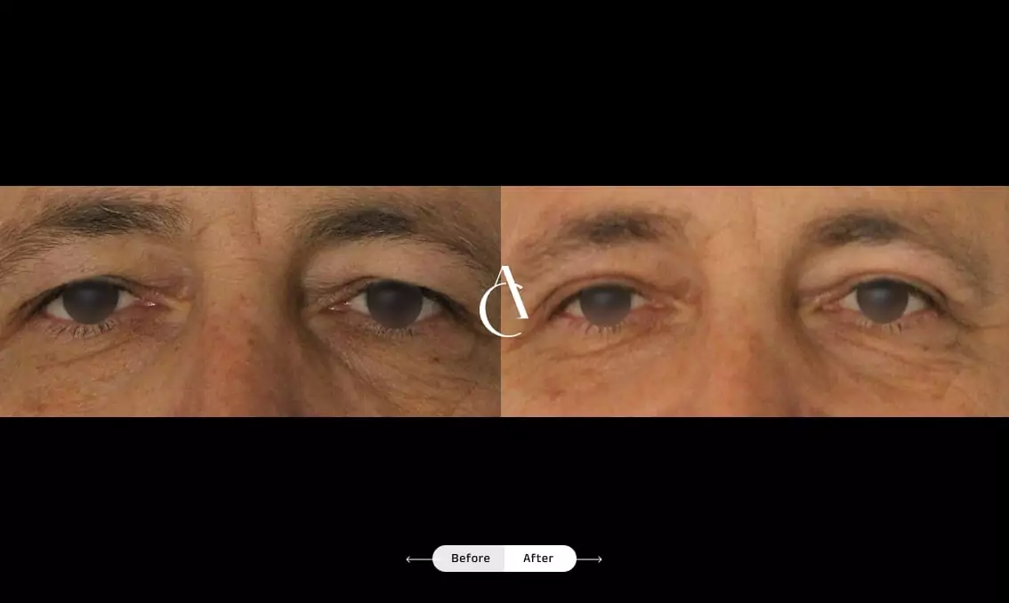 TP – Plastic surgery face – 16 TP – Plastic surgery face – 16