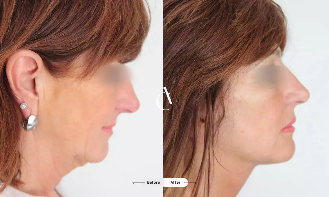 TP – Plastic surgery face – 4 TP – Plastic surgery face – 4