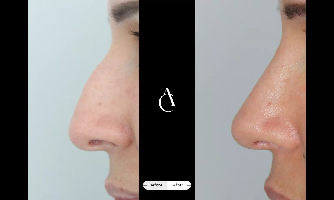 TP – Primary Rhinoplasty – 4