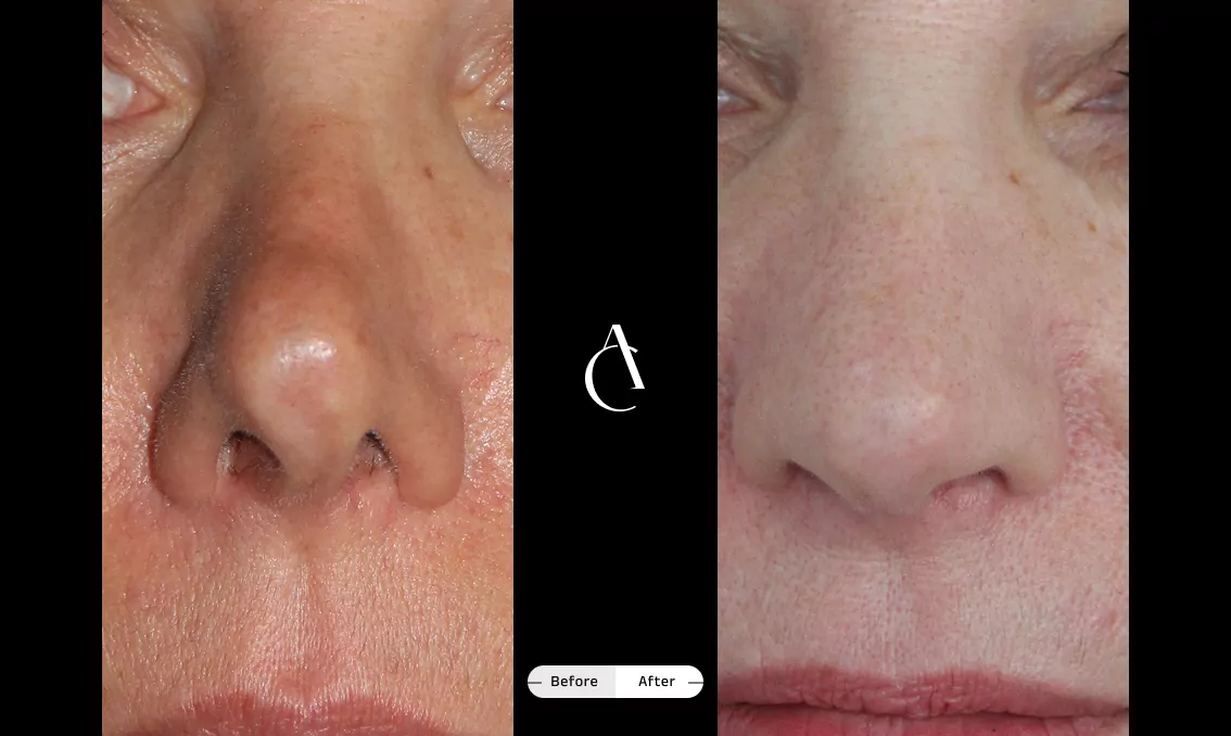 TP - Rhinoplastie de révision - 1