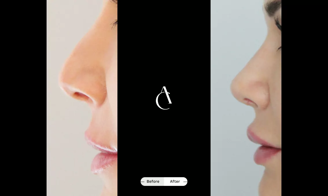 TP - Rhinoplastie de révision - 2