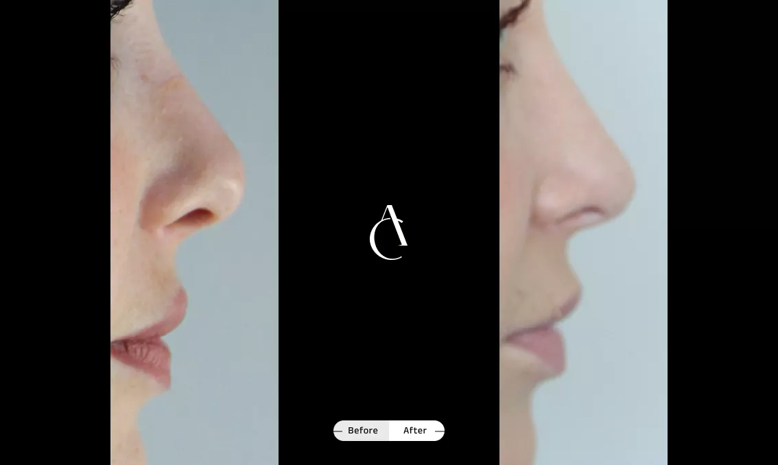 TP - Rhinoplastie de révision - 3