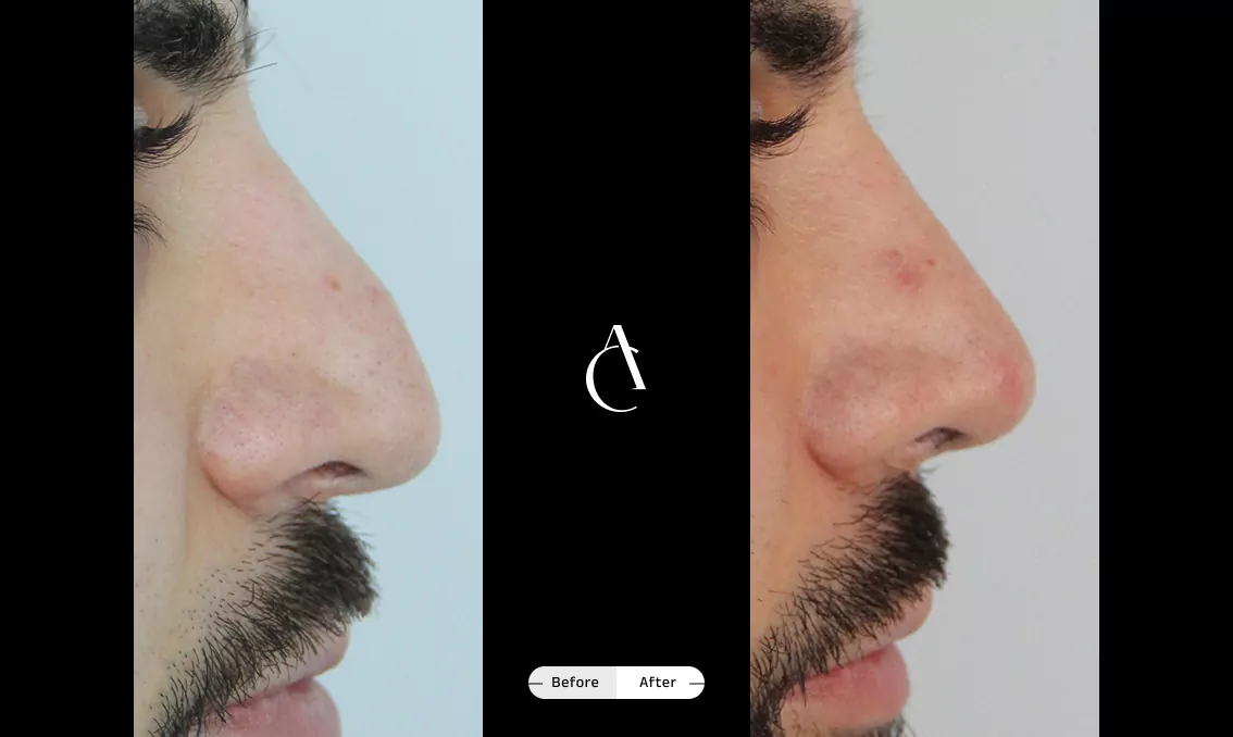 TP – Revision Rhinoplasty – 4
