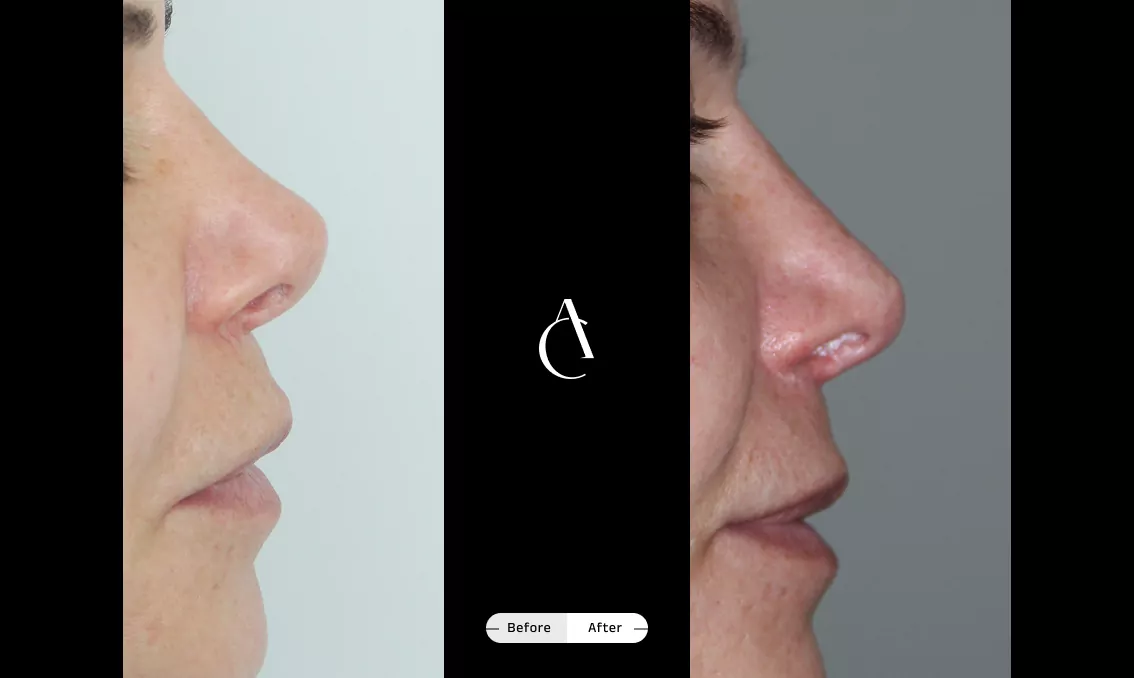 TP - Rhinoplastie de révision - 5
