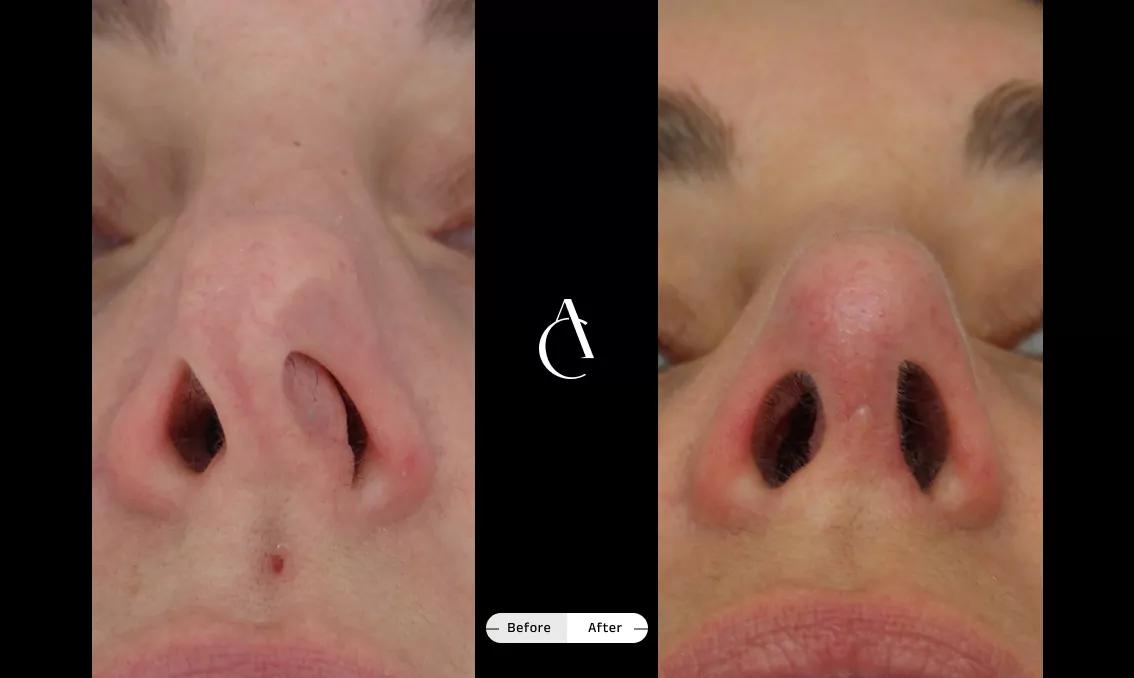 TP – Revision Rhinoplasty – 6