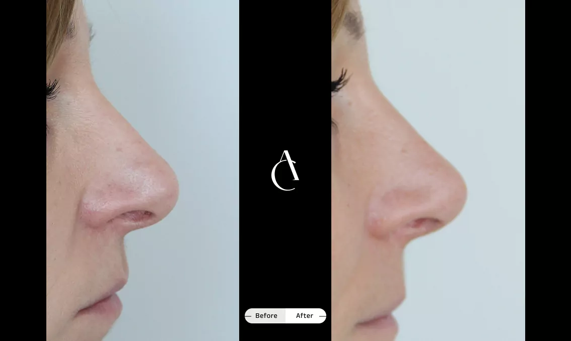 TP - Rhinoplastie de révision - 7