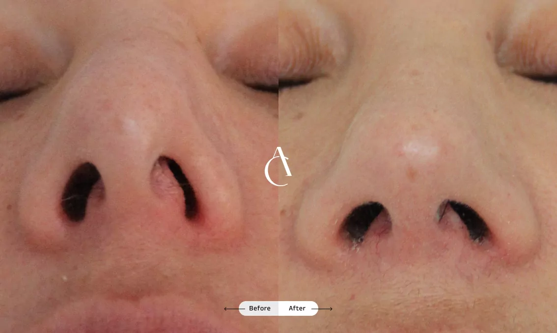 TP - Rhinoplastie de révision - 8