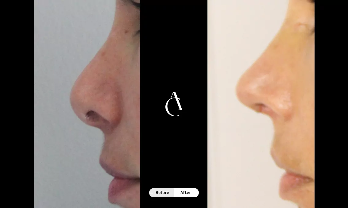 TP – Revision Rhinoplasty – 9